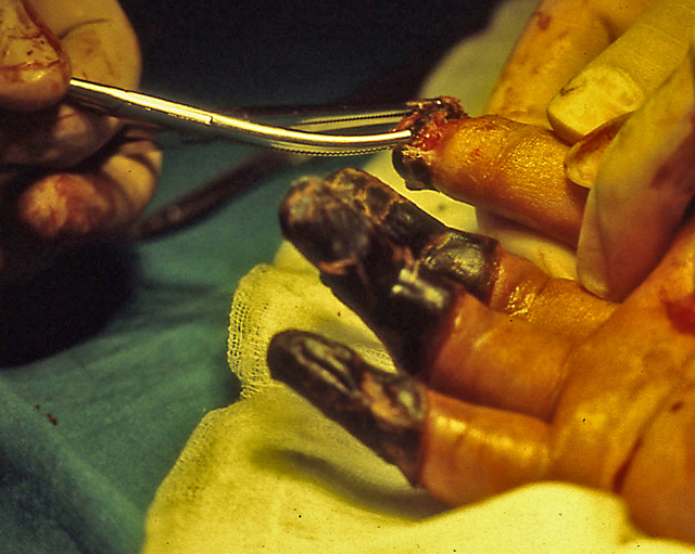 Congelacion-manos-operacion
