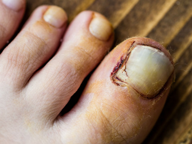 Cómo prevenir la aparición de uñas negras en los pies